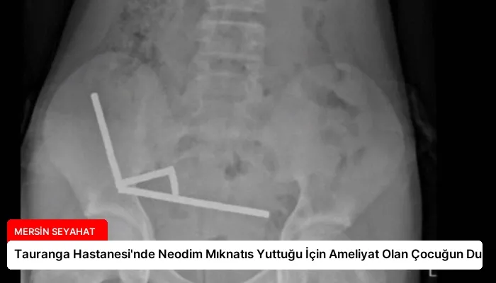Tauranga Hastanesi’nde Neodim Mıknatıs Yuttuğu İçin Ameliyat Olan Çocuğun Durumu